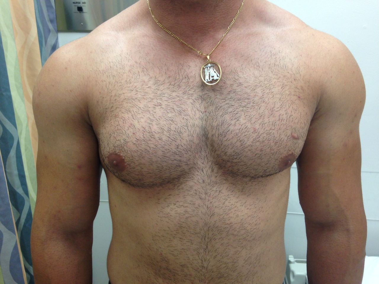 Pectoralis Major Tear